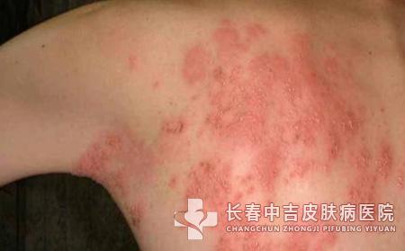换季呼吸道感染怎么办?