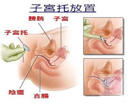 如何改善产后子宫脱垂尿失禁频尿