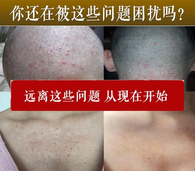 治疗痘痘的外用药有哪些