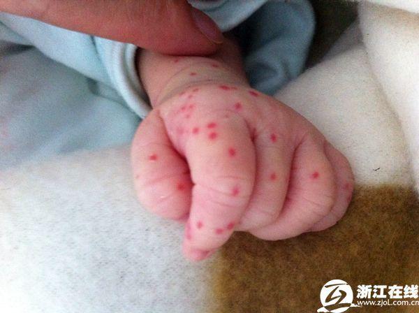 4个月小孩被蚊子咬了怎么办