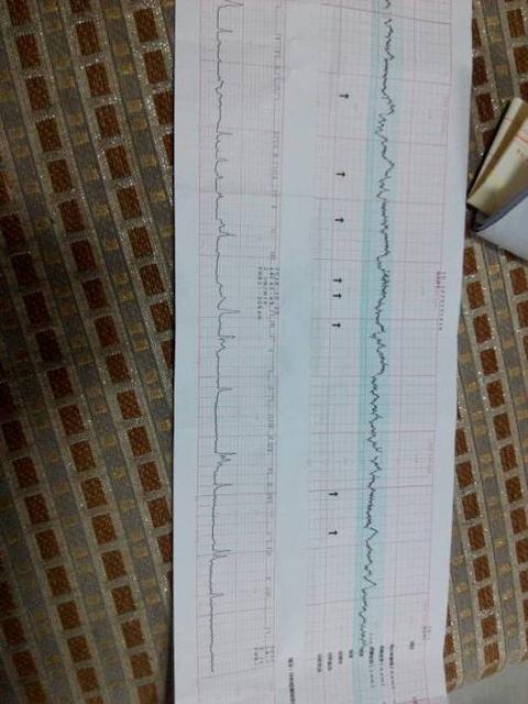 胎心监护有哪些异常情况