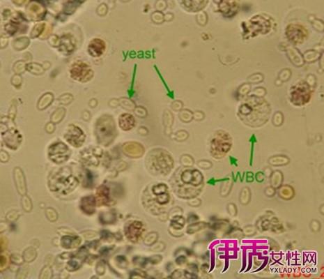 小孩白细胞高是什么原因造成的