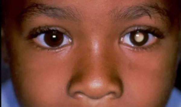 孩子瞳孔发白是先天性白内障瞳孔发白是白内障吗
