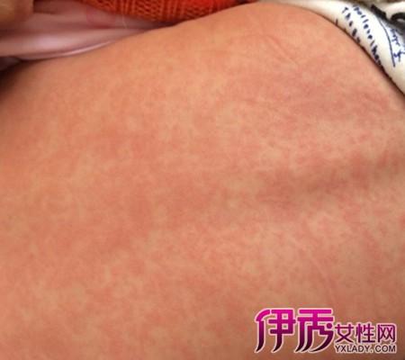 孩子幼儿急疹应该怎么护理