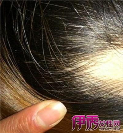 儿童有脱发是什么原因