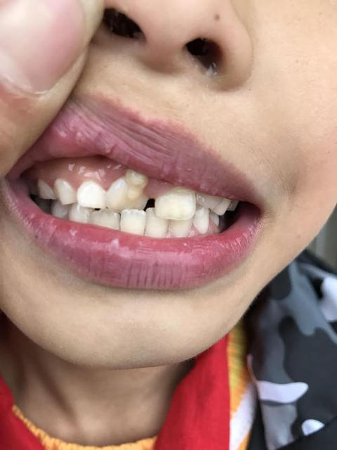 小孩子吞不下药片怎么办