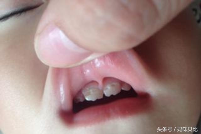 乳牙龋病需要治疗吗