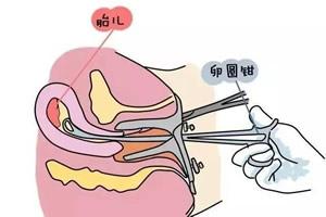 怀孕5个月引产的注意事项