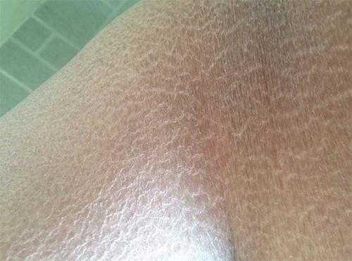 宝宝夏季皮炎怎么办