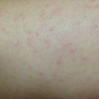 孩子身上总起疹子怎么回事