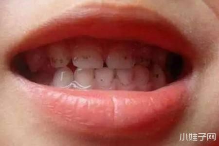 小孩子牙菌斑是怎么形成的