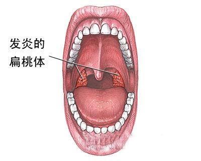 为什么幼儿不能轻易切除扁桃体