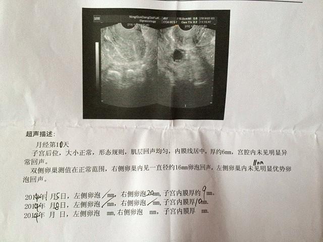 女人有卵巢囊肿可以怀孕吗