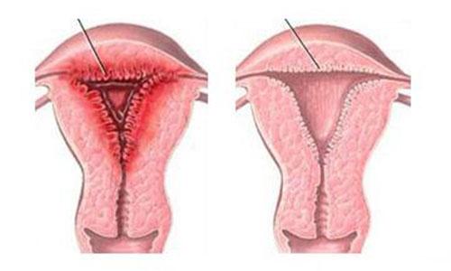 有子宫内膜炎怎么治疗最好