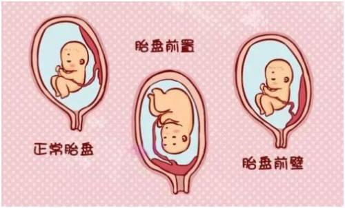 前置胎盘和胎盘位于前壁有什么区别