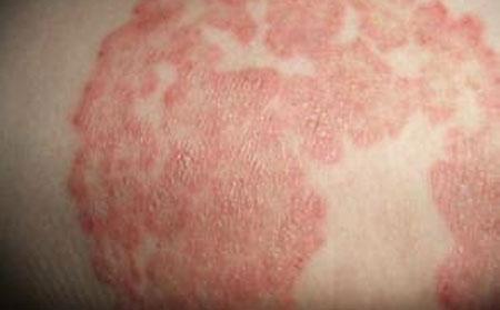 如何有效护理湿疹该如何预防护理湿疹