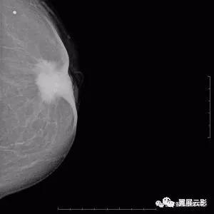 如何判断乳头内陷的程度