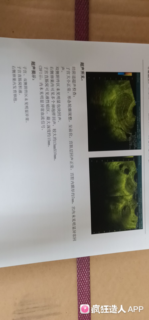 胖多囊促排第一次成功