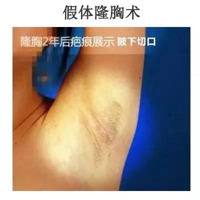 吸脂以后皮肤会不会松弛