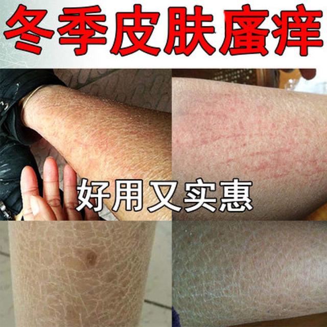 冬季如何预防皮肤瘙痒