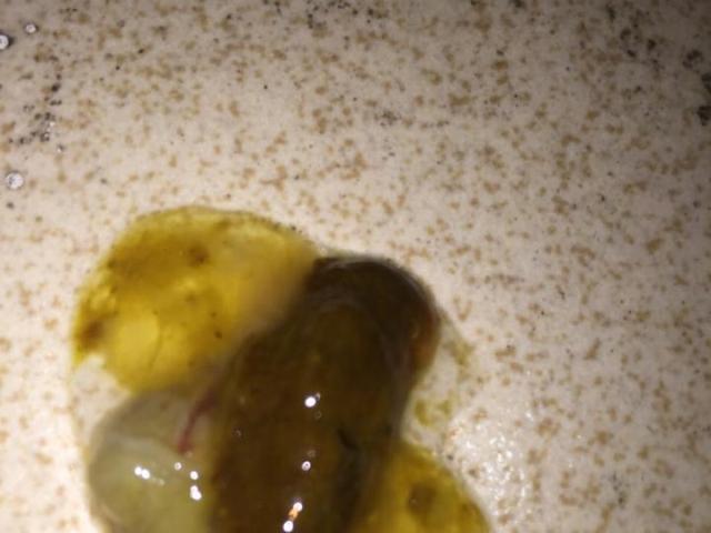 宝宝拉肚子有血丝怎么办