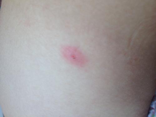 四岁宝宝突然发烧怎么回事