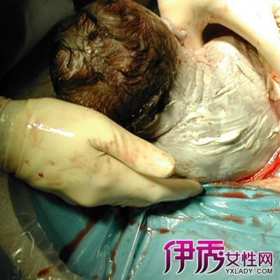 剖宫产伤口痛怎么办