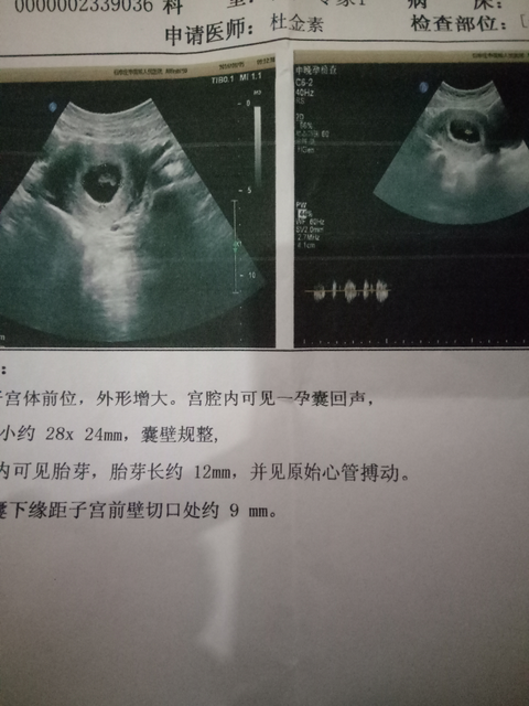 怀孕45天孕囊大小标准图片