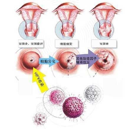宫颈炎对孕妇有什么影响