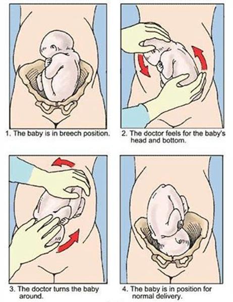 胎位不正是臀位怎么办