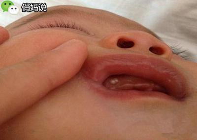 宝宝出生就有马牙是怎么回事