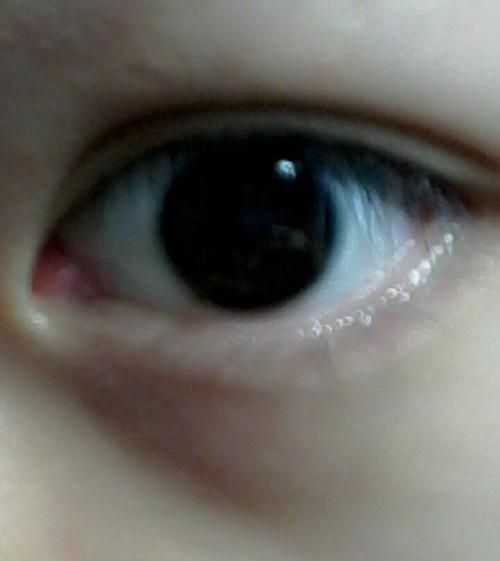 问右眼角内红肿偶尔有痒涩的感觉但不感觉明显左右眼比较眼角