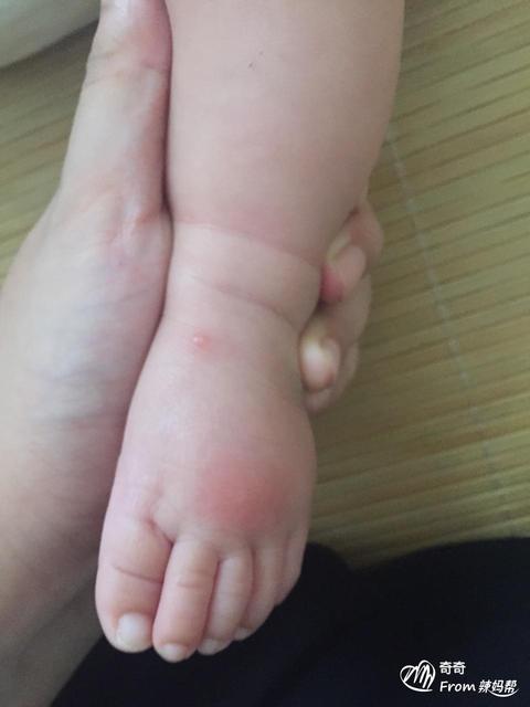 小孩总爱被蚊虫叮咬咋办