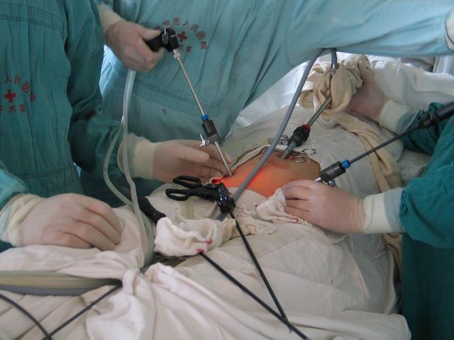 宫外孕手术微创图片图片