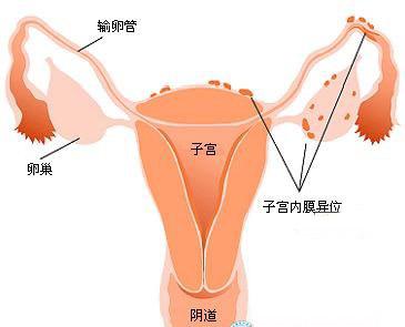 剖腹产子宫内膜异位症手术怎么做