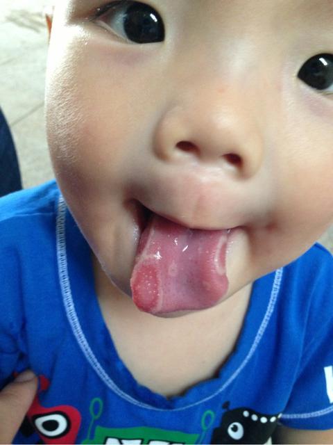 宝宝地图舌有什么症状