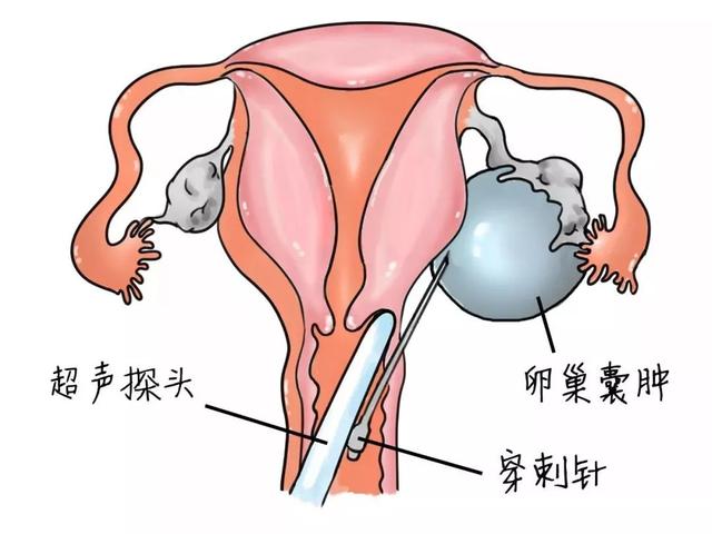 怀孕有卵巢囊肿要注意些什么
