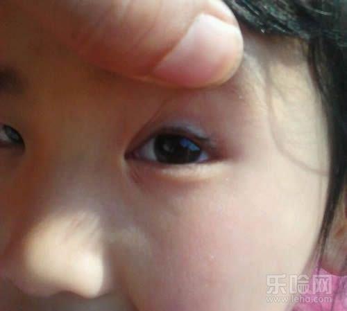 婴儿倒睫毛长大会好吗