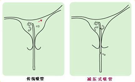 孕囊多少mm可以做人流南宁