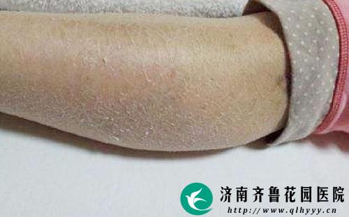 冬季皮肤干燥脱皮咋办