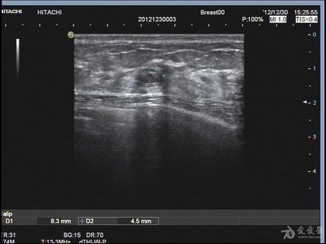 乳腺炎脓肿如何照顾宝宝