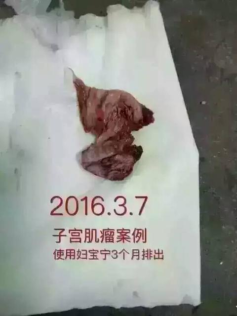 慢性宫颈炎会导致不孕不育吗