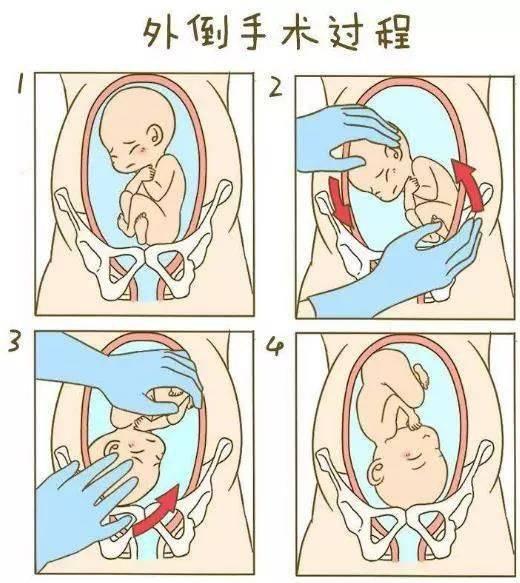 臀位外倒转术最佳时间