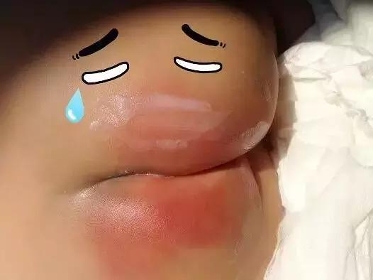 宝宝红屁屁怎么快速消除小妙招