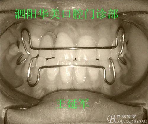 唇腭裂术后正畸案例