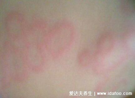 幼儿急疹的症状有哪些表现