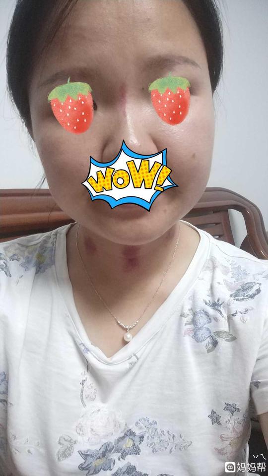 于是老娘我想到了一个古老的办法,揪脖子,但是不敢刮痧,因为你太弱,我