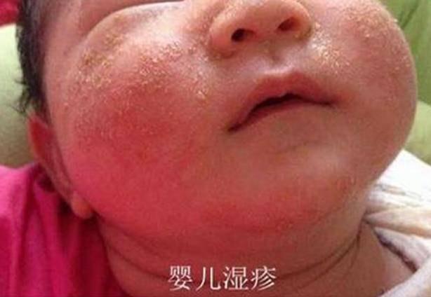 什么样的疹子是皮炎和湿疹