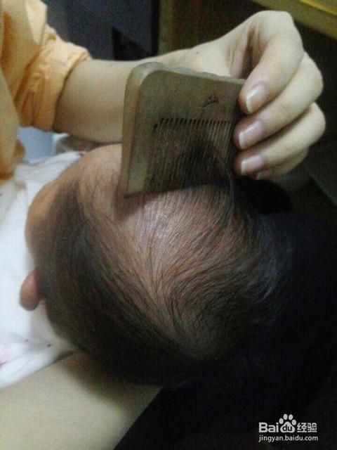 新生婴儿头垢怎么处理