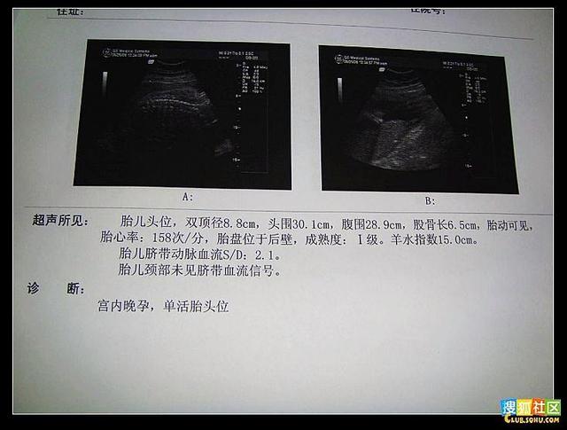 怀孕期间需要做几次b超检查